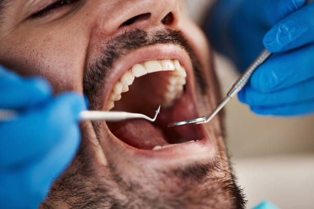 Best Emergency Dentist for Lost Fillings or Crowns in Wayne, PA